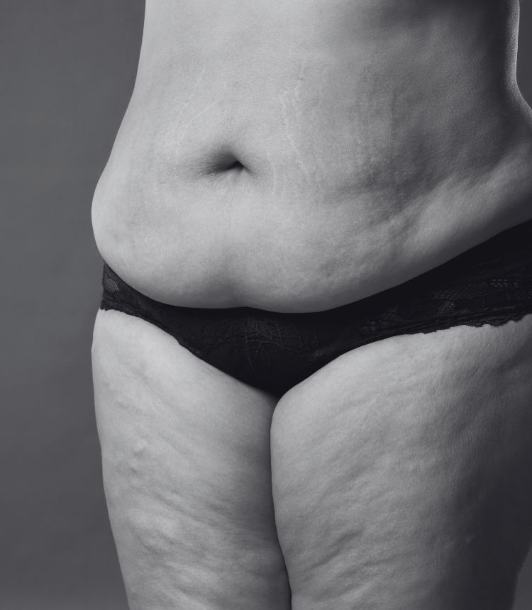 Image comparing mild and severe cellulite grades Bexleyhill