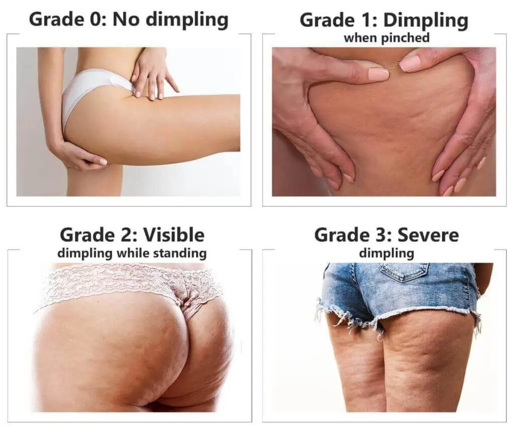 Representation of the stages of cellulite development Bexleyhill